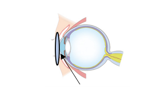 頂点間距離０㎜