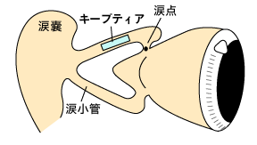 図：涙小管に挿入するプラグ