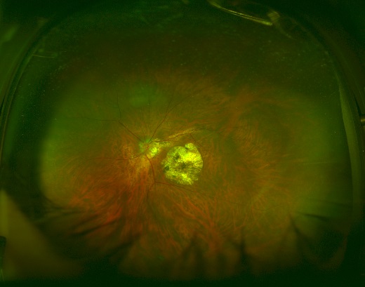 強度近視による網脈絡膜萎縮