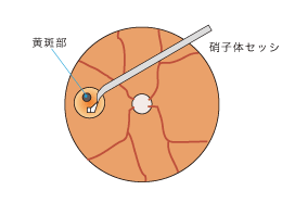 3.黄斑部の内境界膜を剥離する