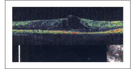 糖尿病黄斑浮腫のOCT画像